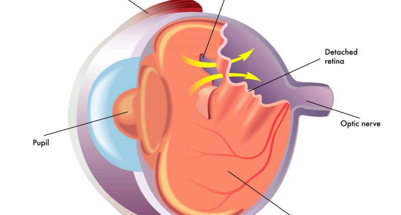 Descolamento de retina: sintomas e tratamento