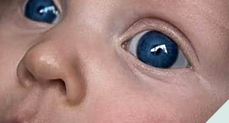 glaucoma em crianças