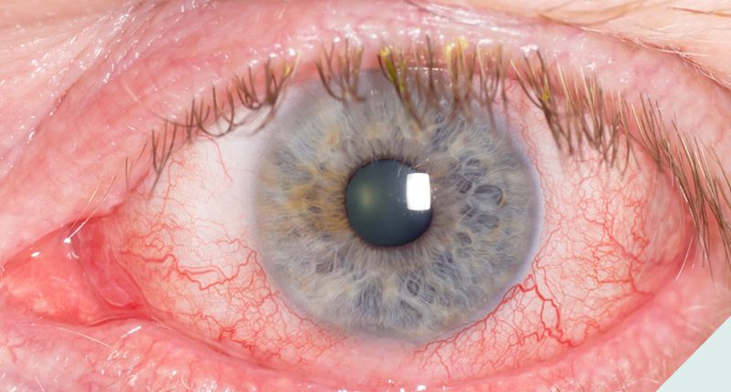 Inflamações Oculares: conheça os 3 tipos mais comuns