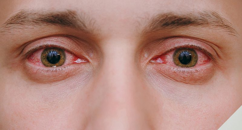 inflamação ocular