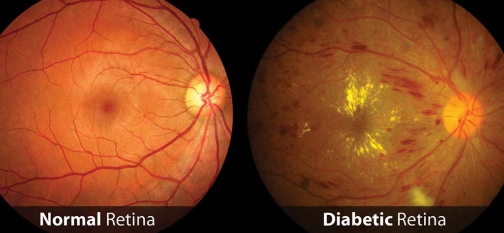 normal retina vs diabetic retinopathy
